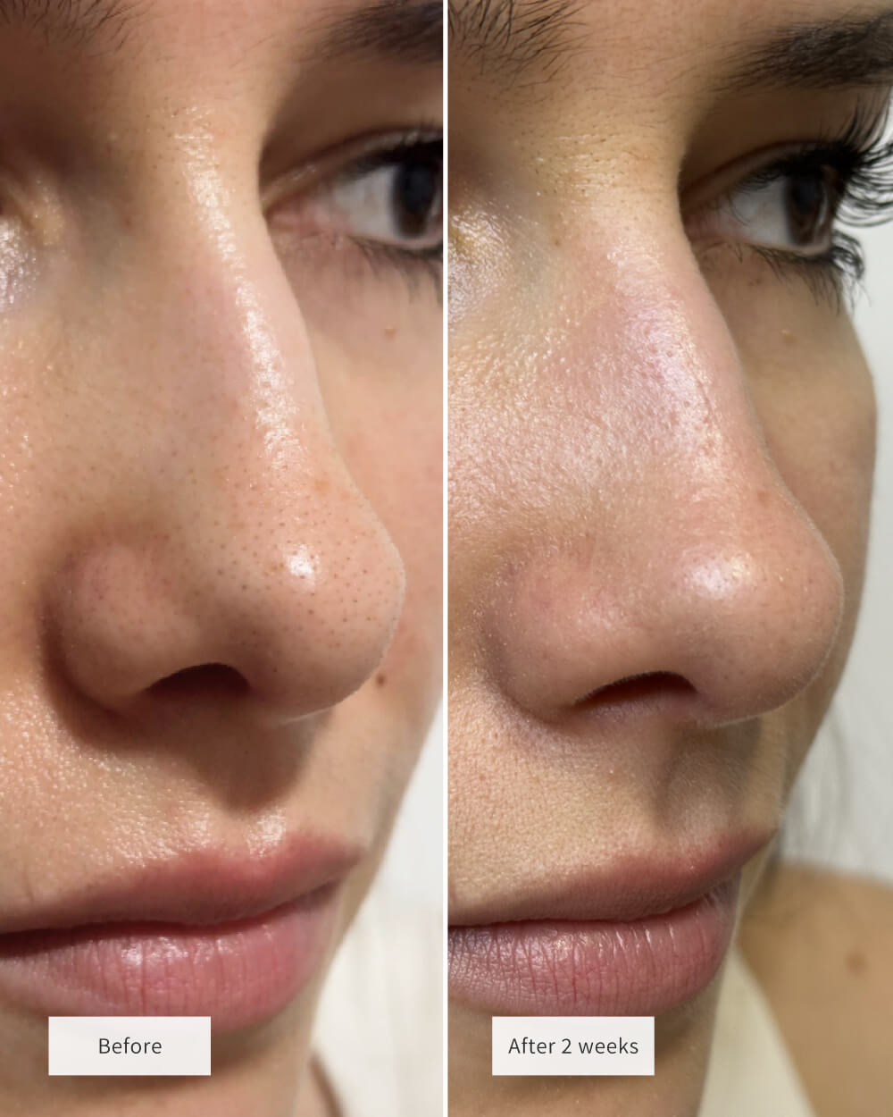 Junazilo® 🧄Deep-Clean Nose Strips – Removes Blackheads & Tightens Pores