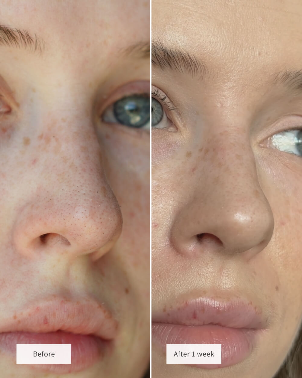 Junazilo® 🧄Deep-Clean Nose Strips – Removes Blackheads & Tightens Pores