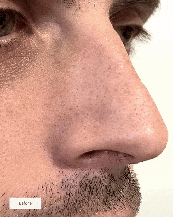 Junazilo® 🧄Deep-Clean Nose Strips – Removes Blackheads & Tightens Pores